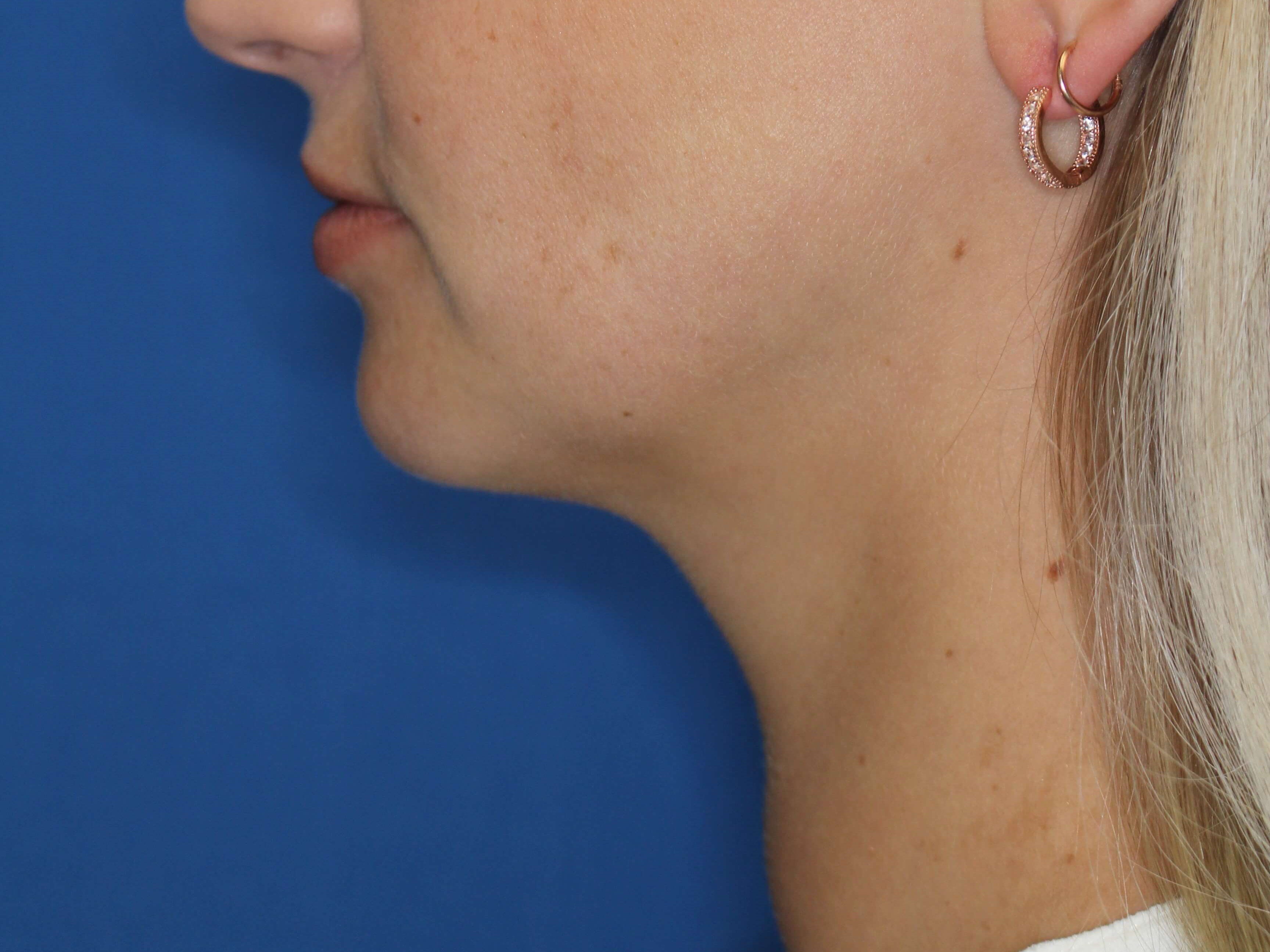 Neck Liposuction After