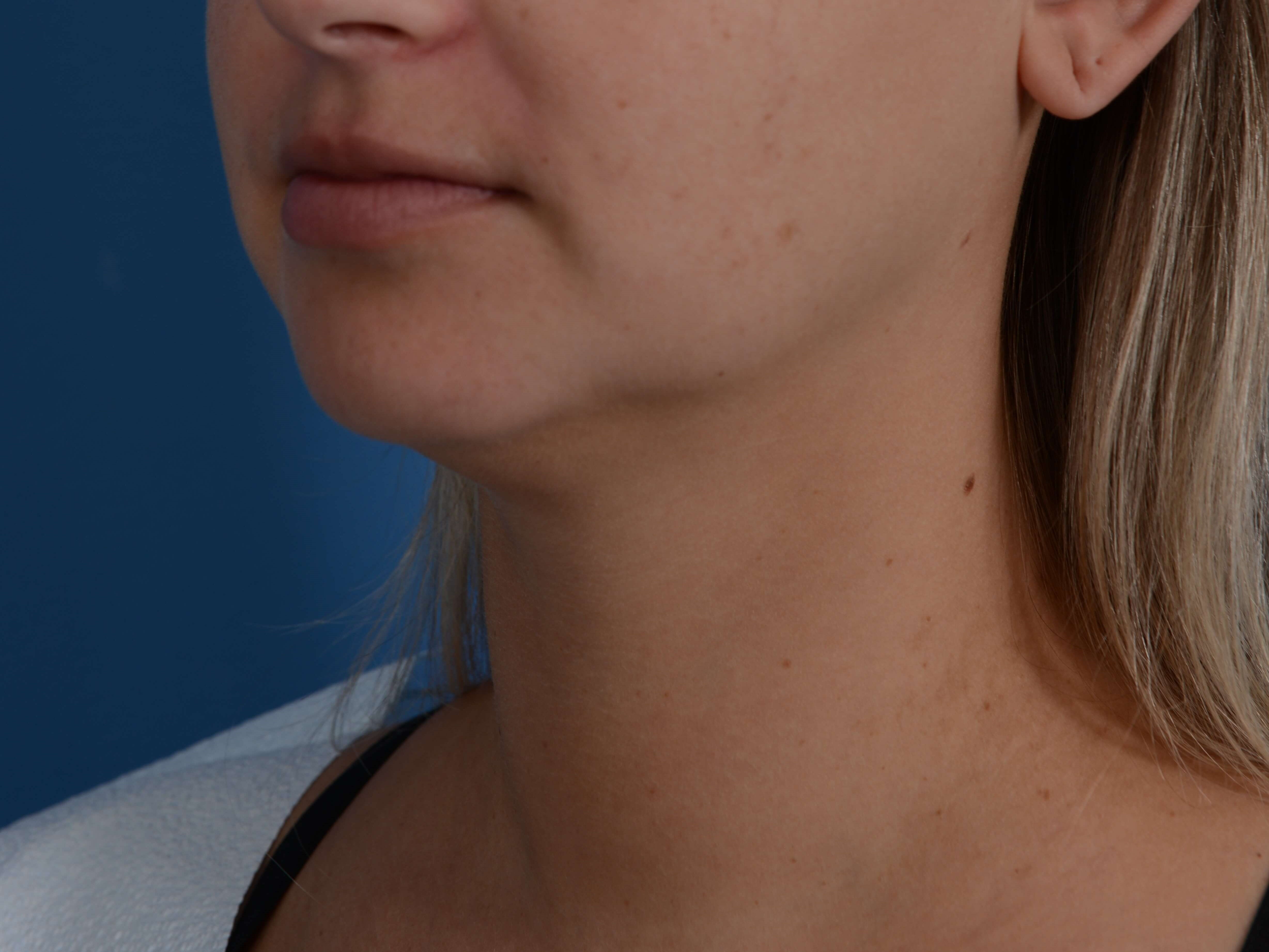 Neck Liposuction Before