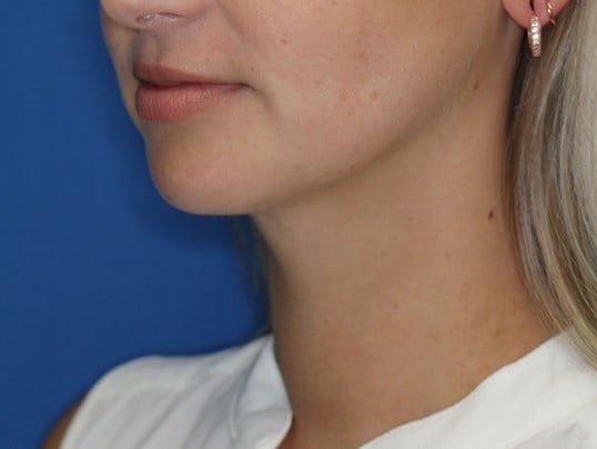 Neck Liposuction After