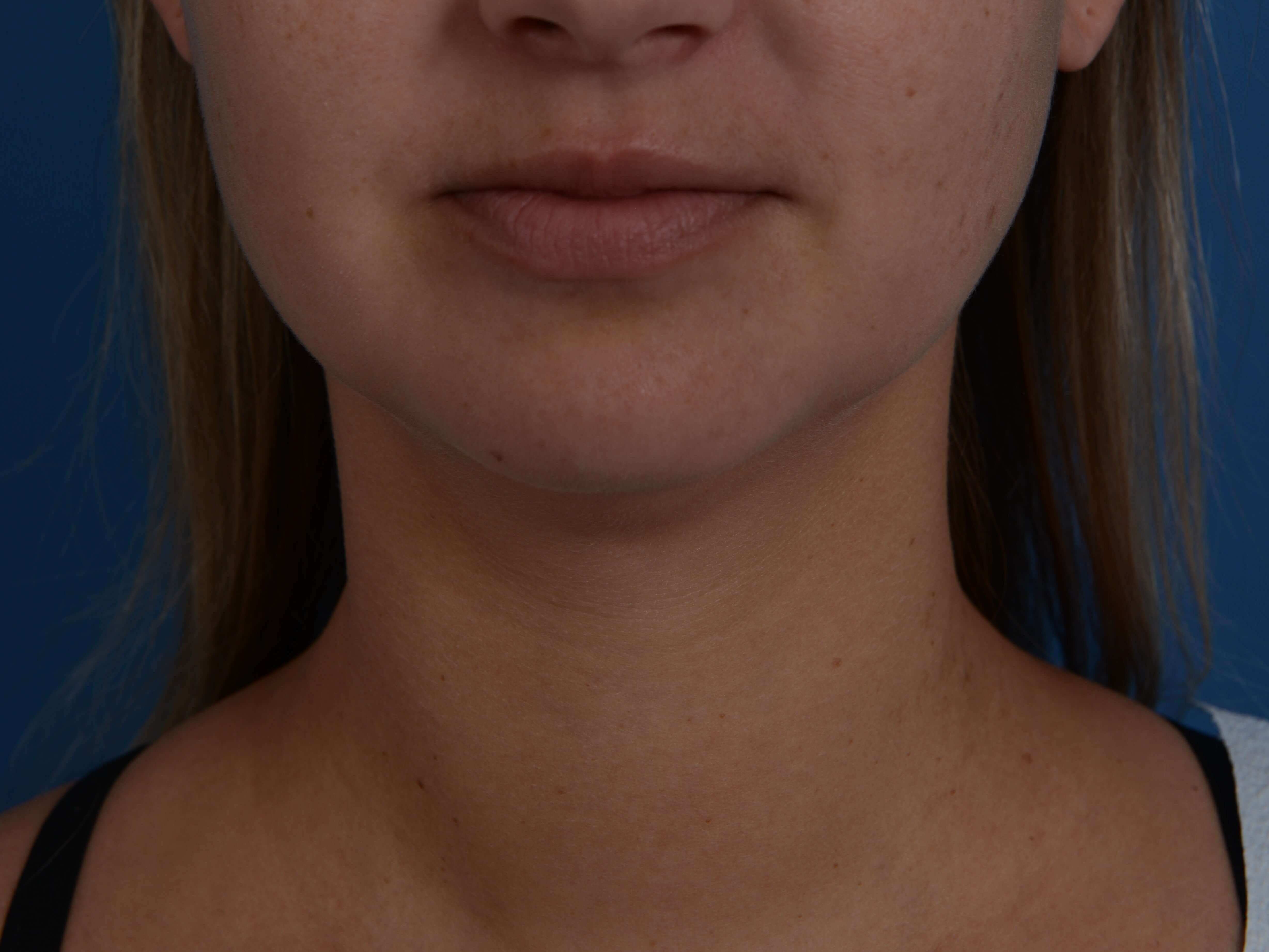 Neck Liposuction Before