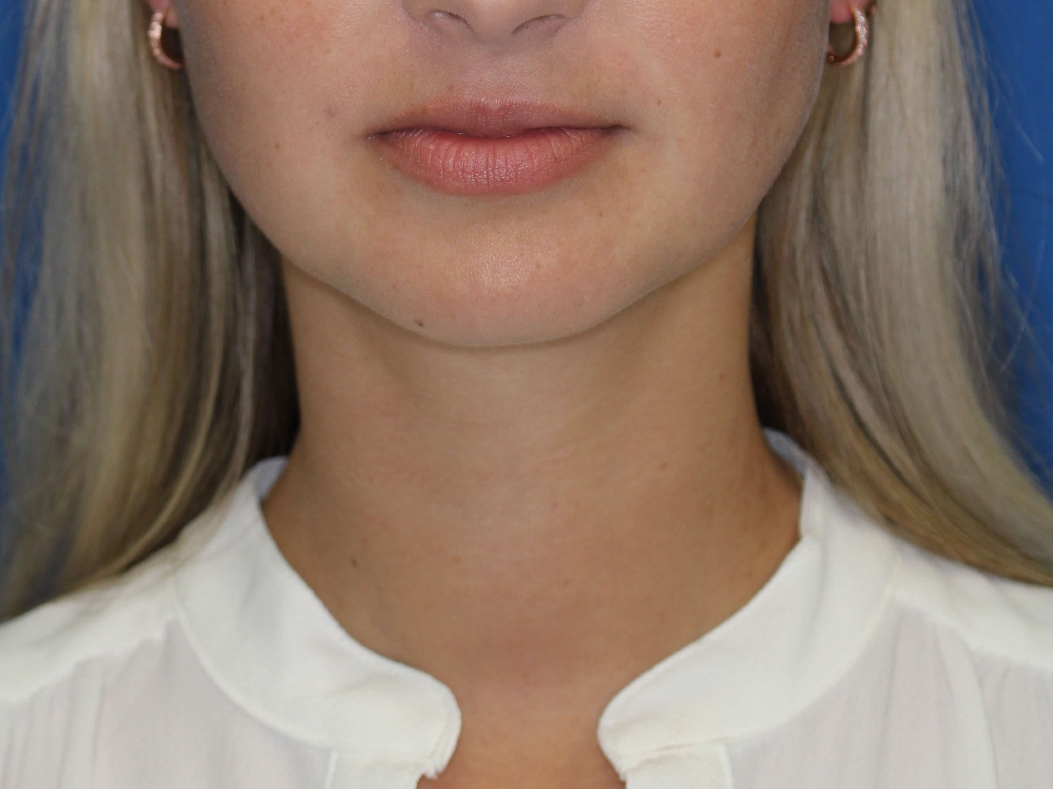 Neck Liposuction After