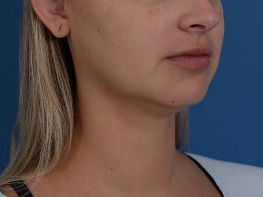 Neck Liposuction Before