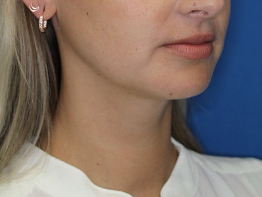 Neck Liposuction After