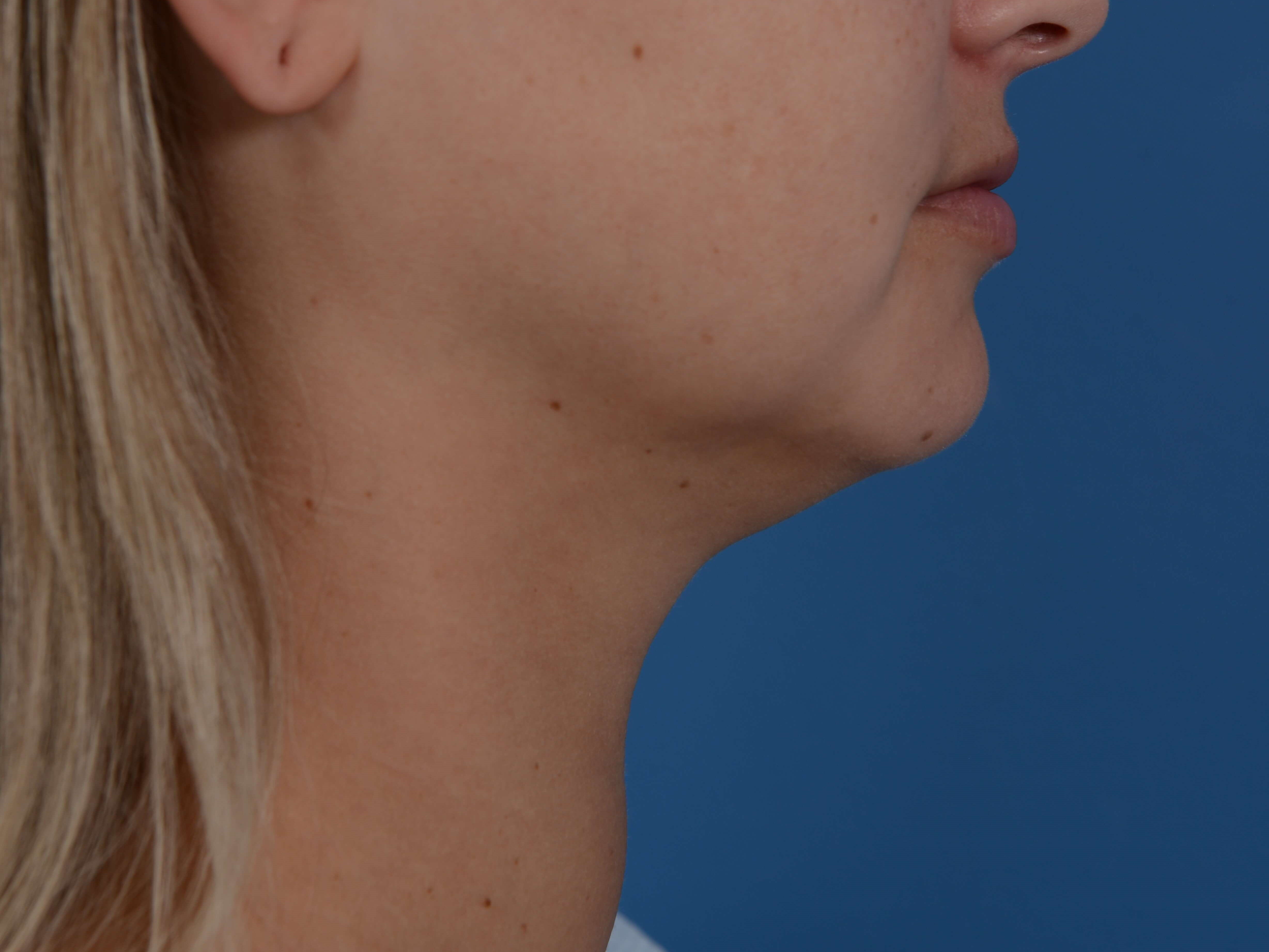Nonsurgical Jaw Contouring Before