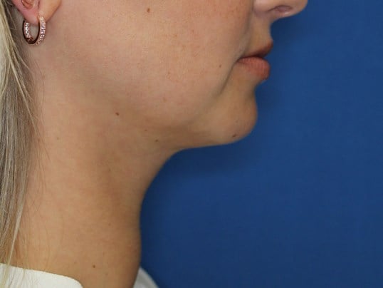 Nonsurgical Jaw Contouring After