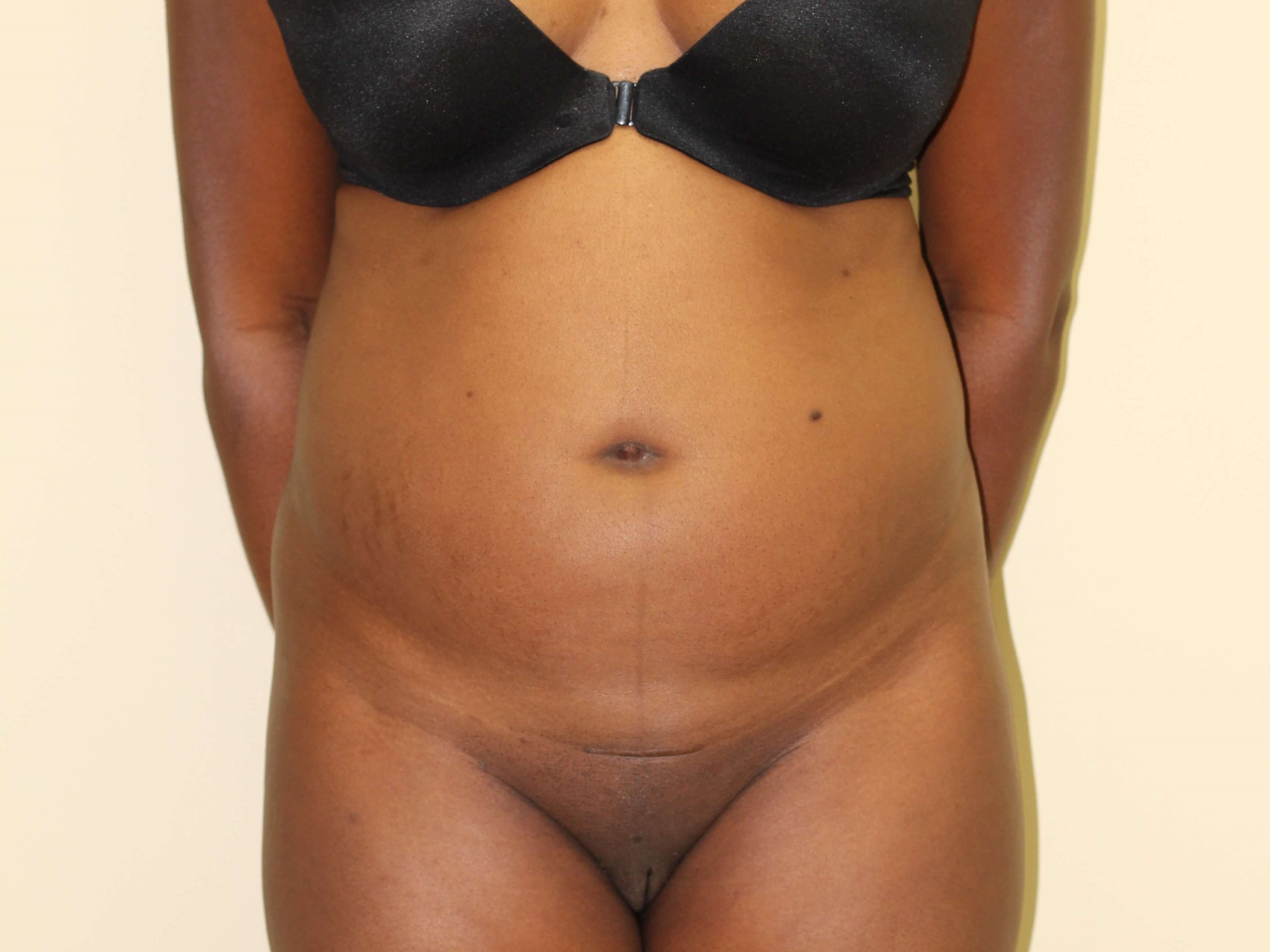 Liposuction & BBL Before