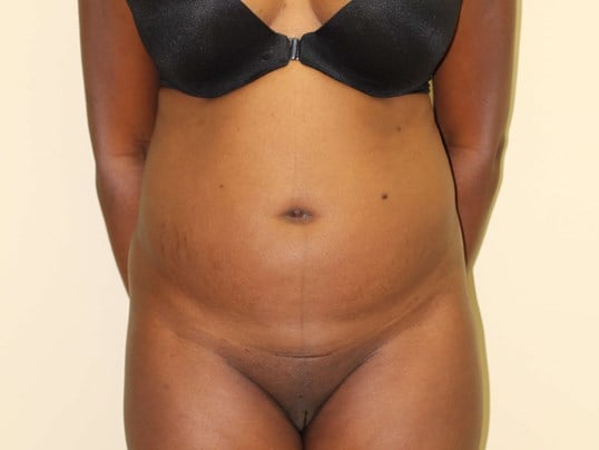 Liposuction & BBL Before