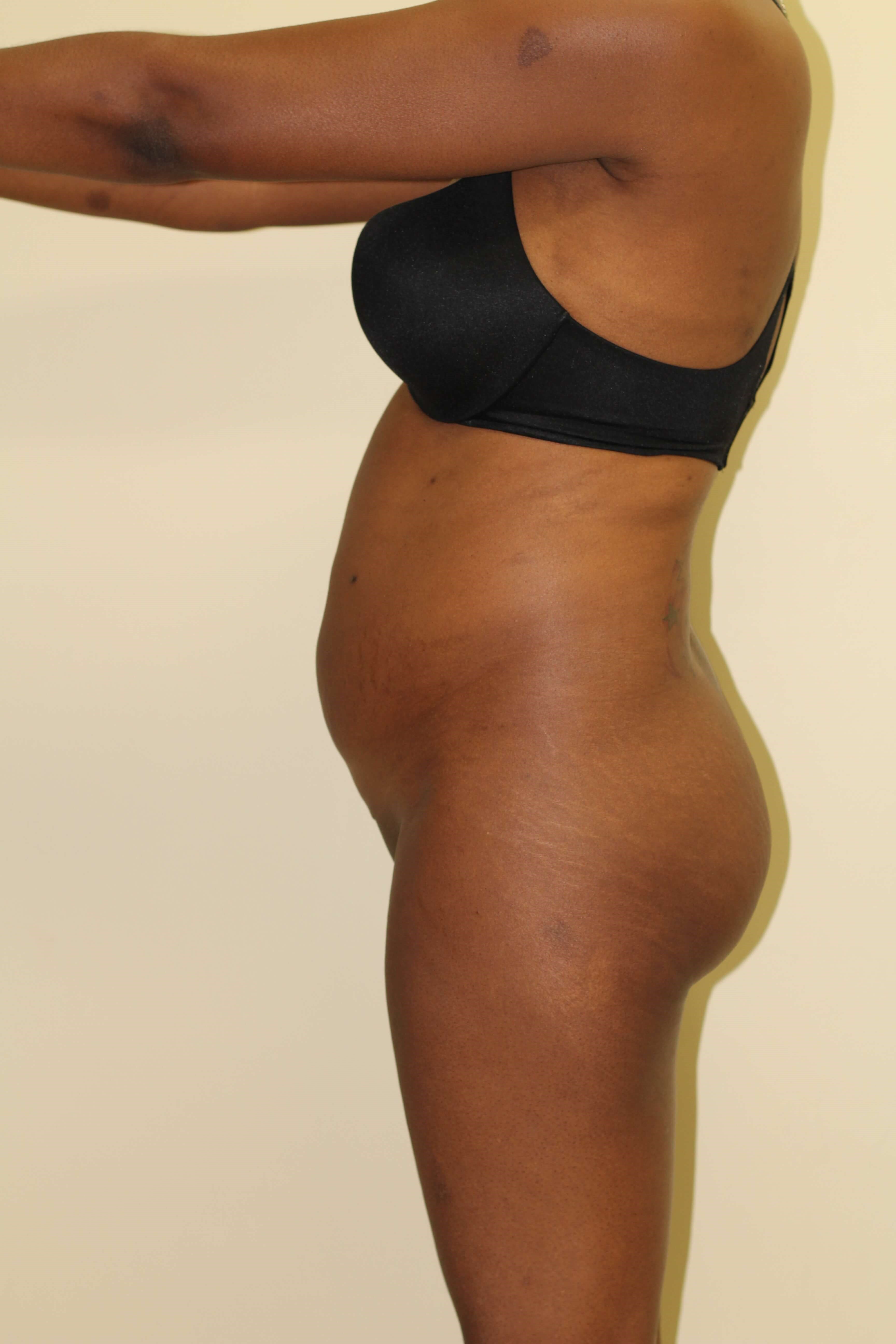 Liposuction & BBL Before