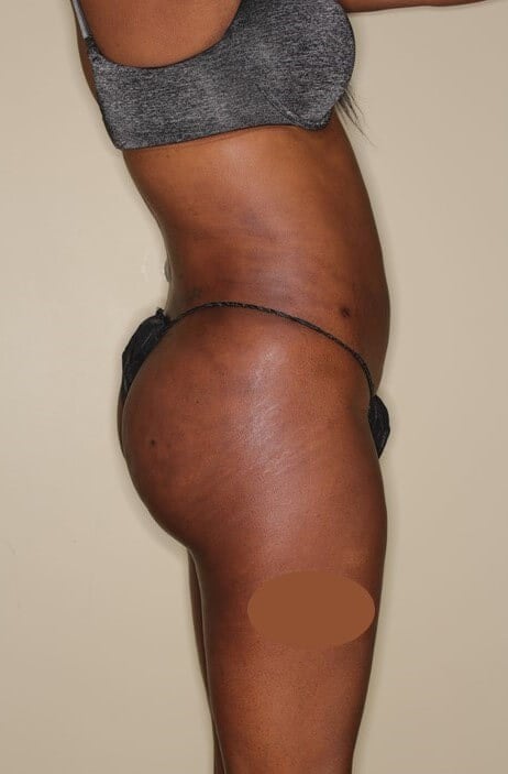 Liposuction & BBL Before