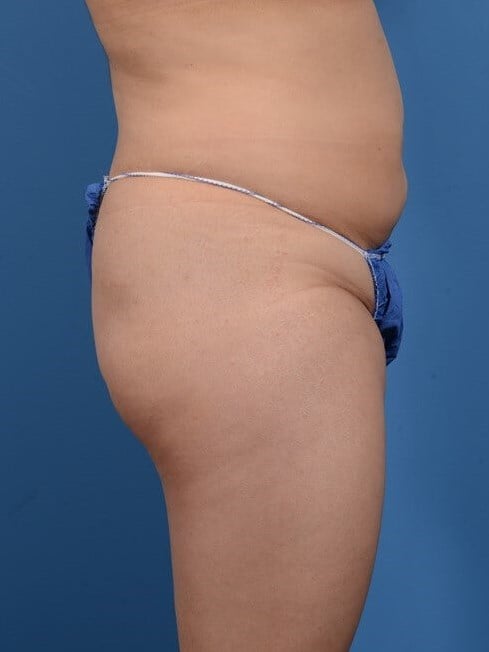 Liposuction & BBL Before