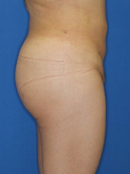 Liposuction & BBL After