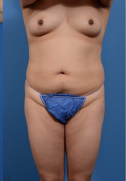 Liposuction & BBL Before
