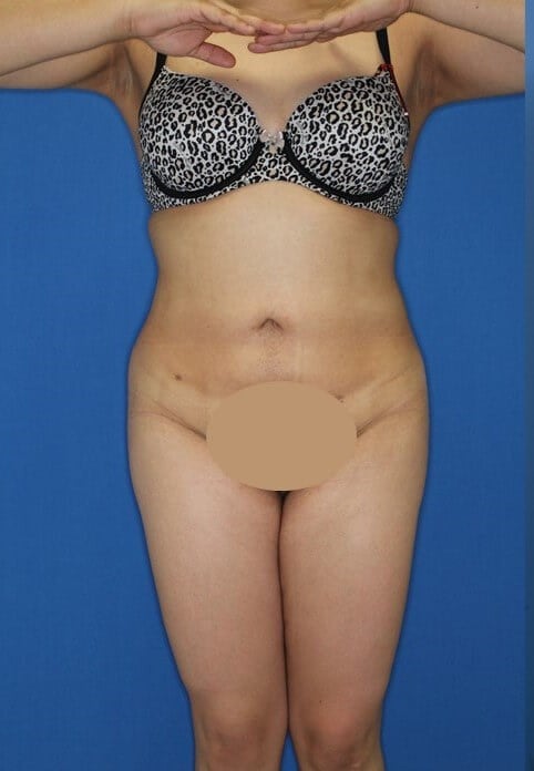 Liposuction & BBL After