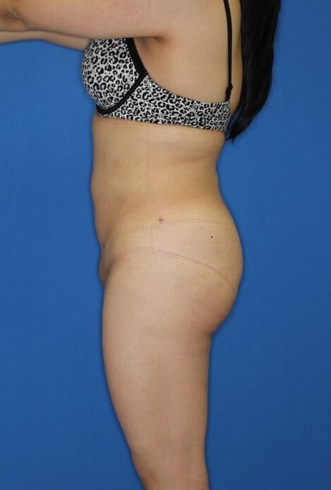 Liposuction & BBL After