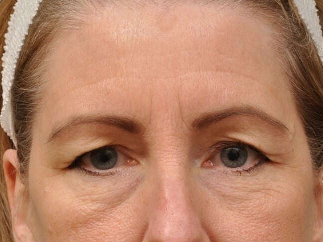 Brow Lift & Upper Eyelid Lift Before
