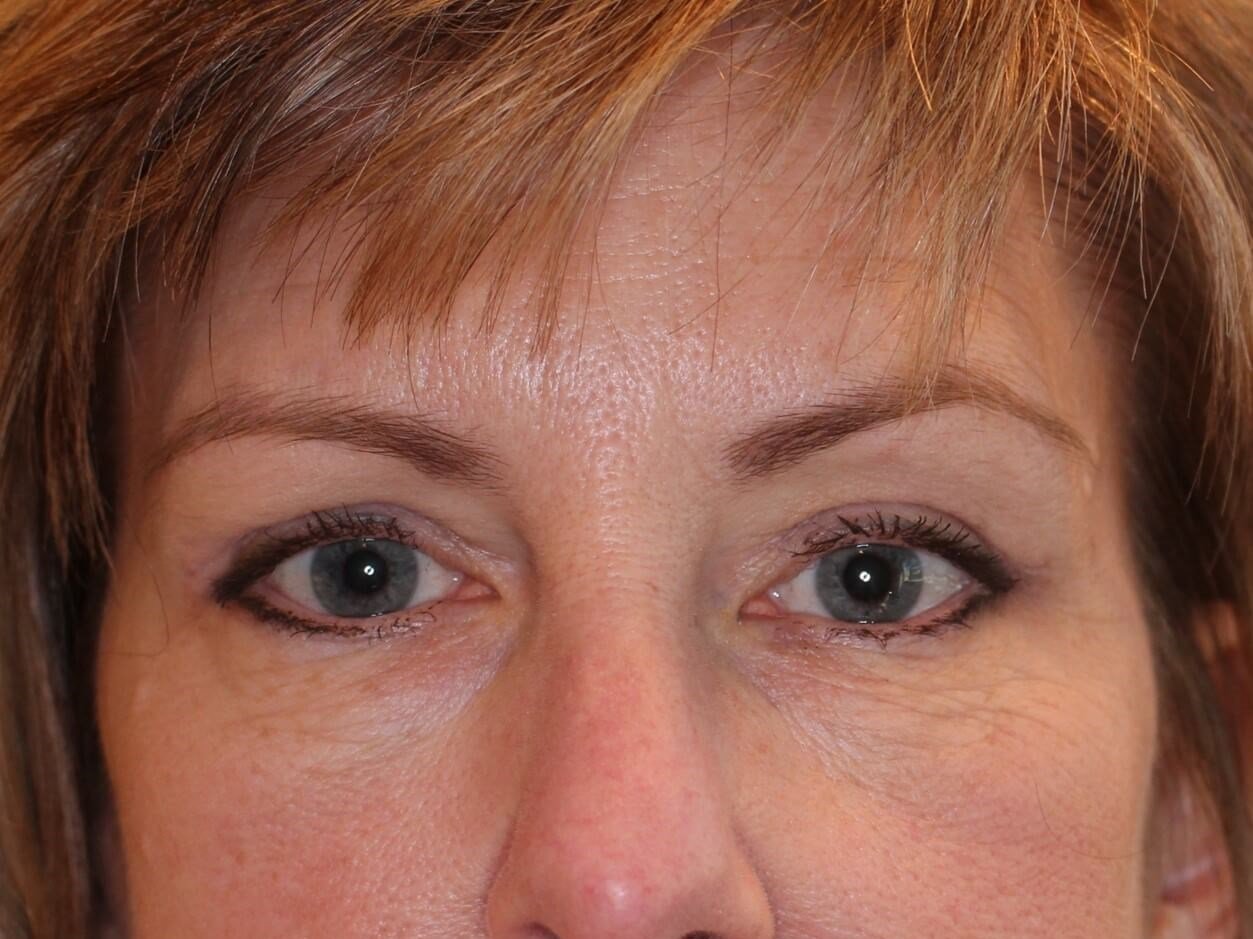 Brow Lift & Upper Eyelid Lift After