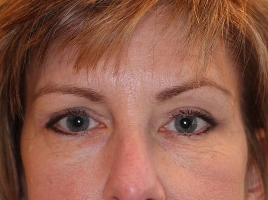 Brow Lift & Upper Eyelid Lift After