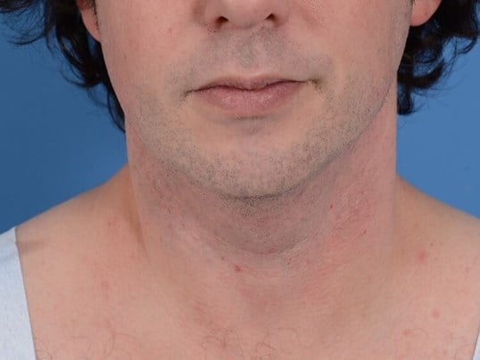 Neck Liposuction Before