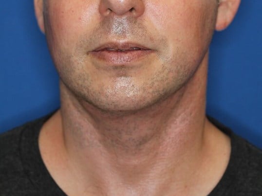 Neck Liposuction After