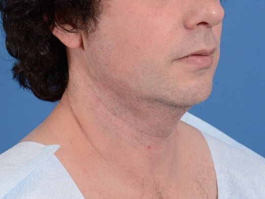 Neck Liposuction Before
