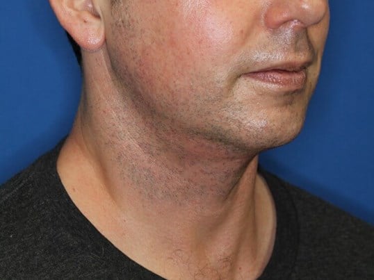 Neck Liposuction After