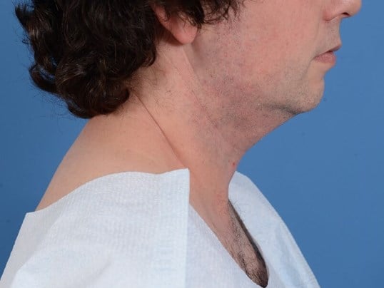 Neck Liposuction Before