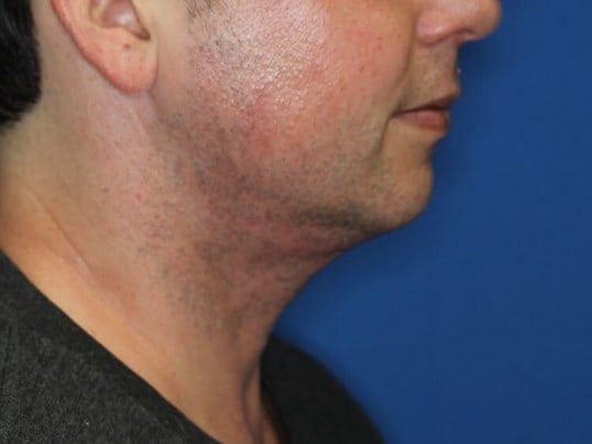 Neck Liposuction After