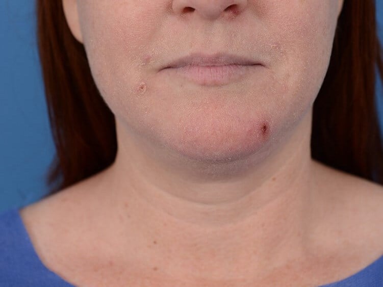 Double Chin Removal Before