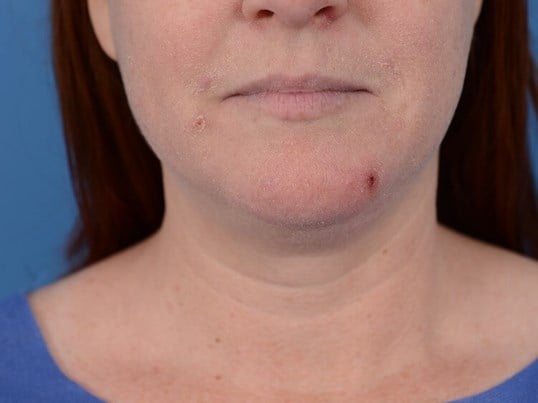 Double Chin Removal Before