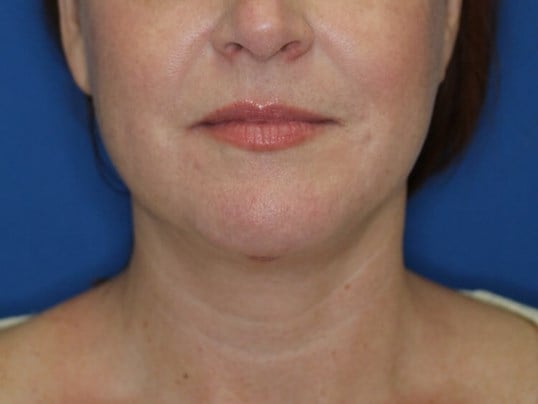 Double Chin Removal After