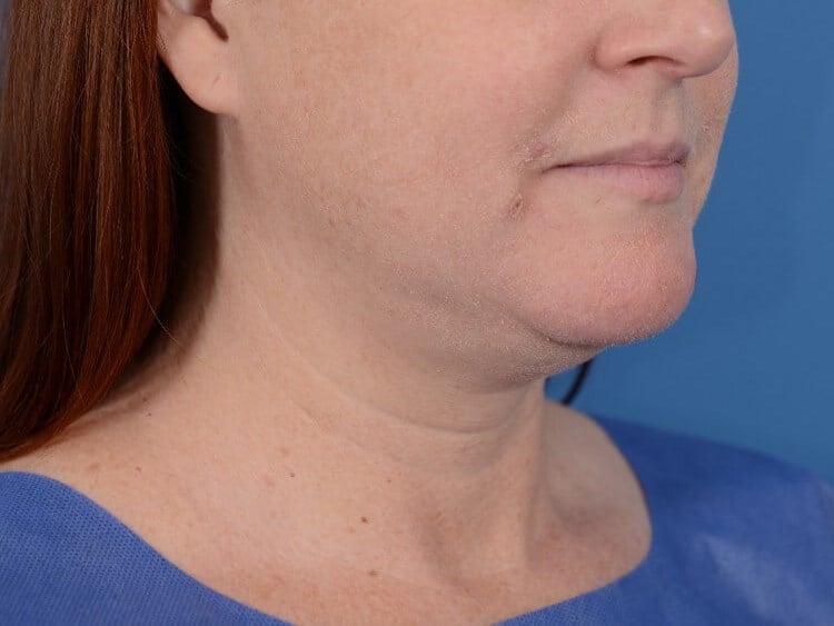 Double Chin Removal Before