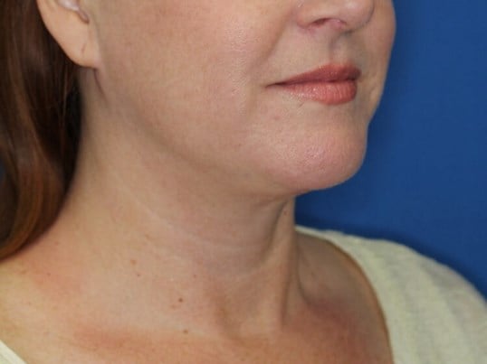 Double Chin Removal After