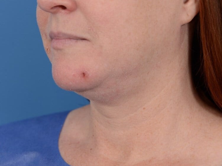 Double Chin Removal Before