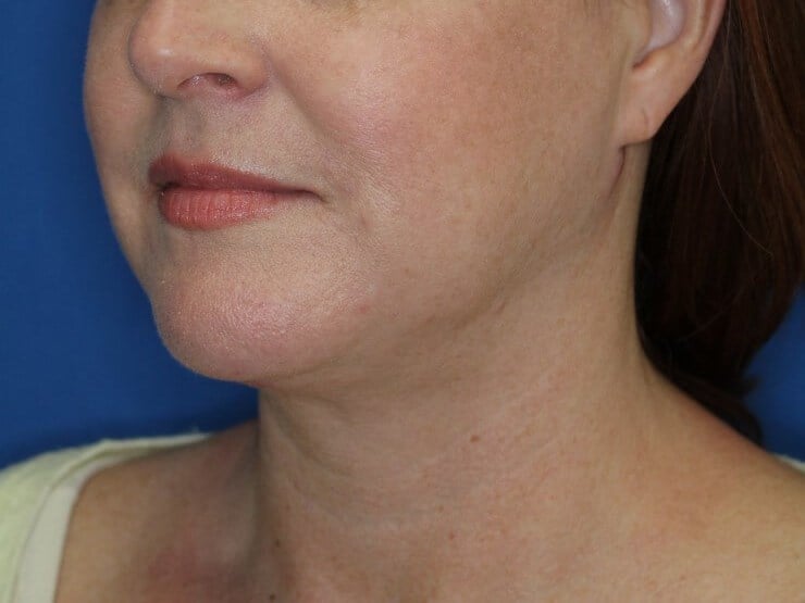 Double Chin Removal After