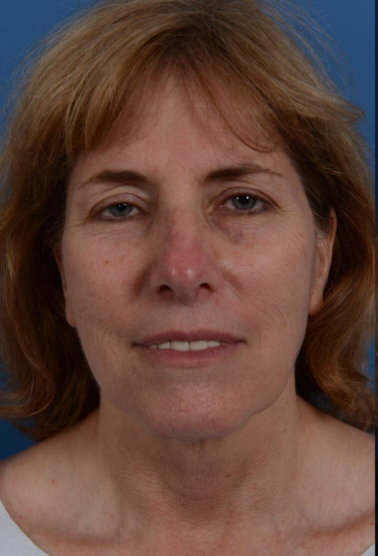 Laser Resurfacing Before