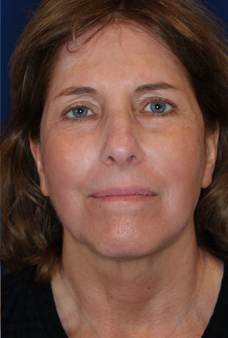 Laser Resurfacing After