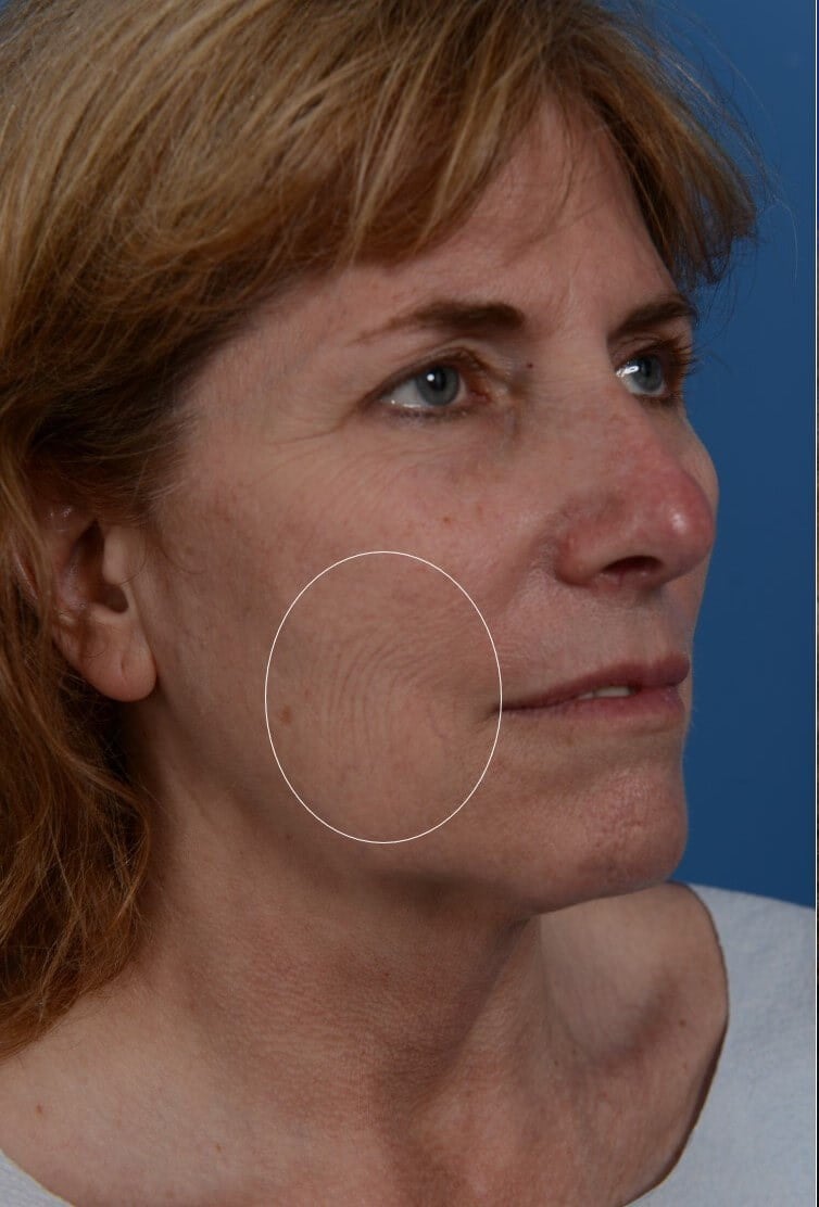 Laser Resurfacing Before