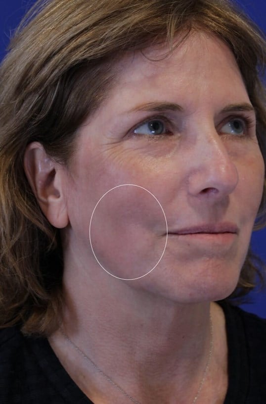 Laser Resurfacing After