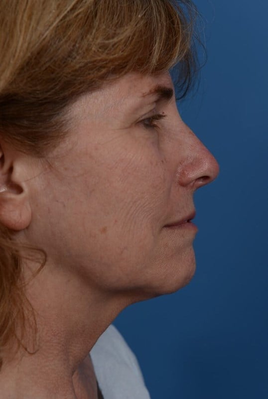 Laser Resurfacing Before