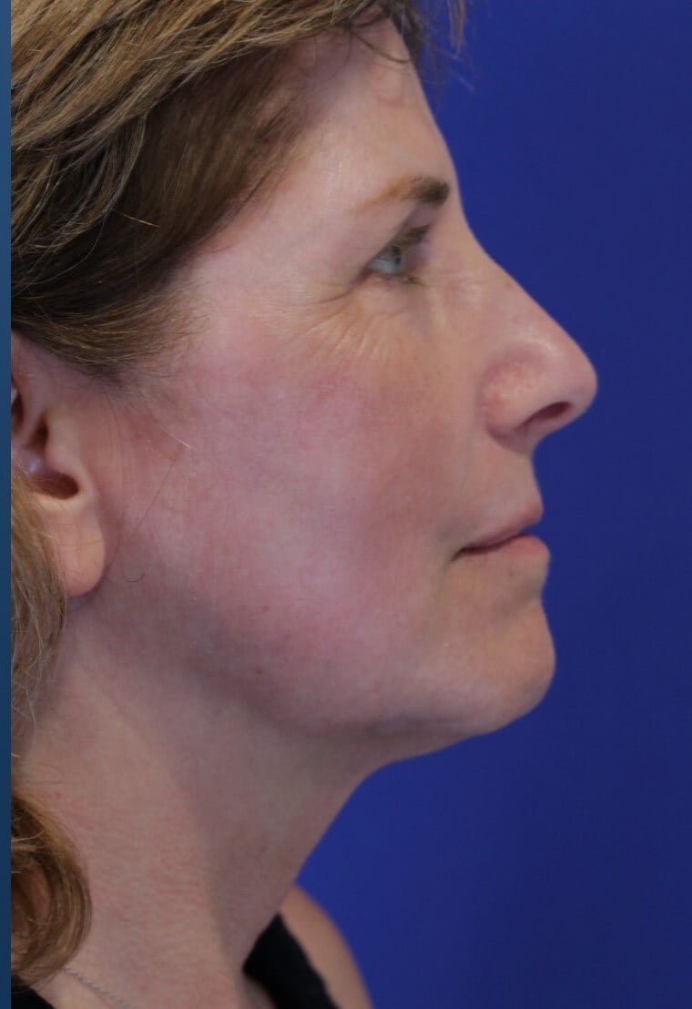Laser Resurfacing After