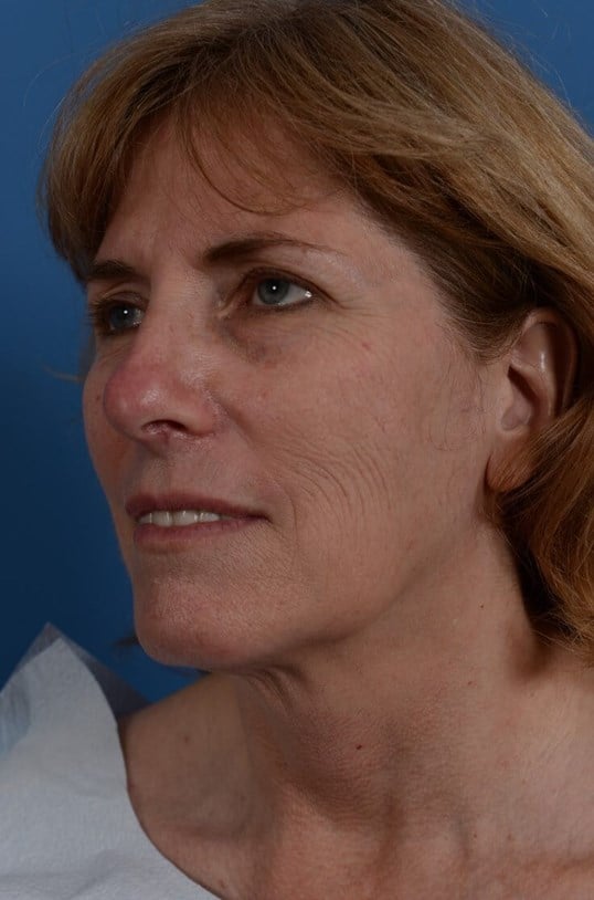 Laser Resurfacing Before