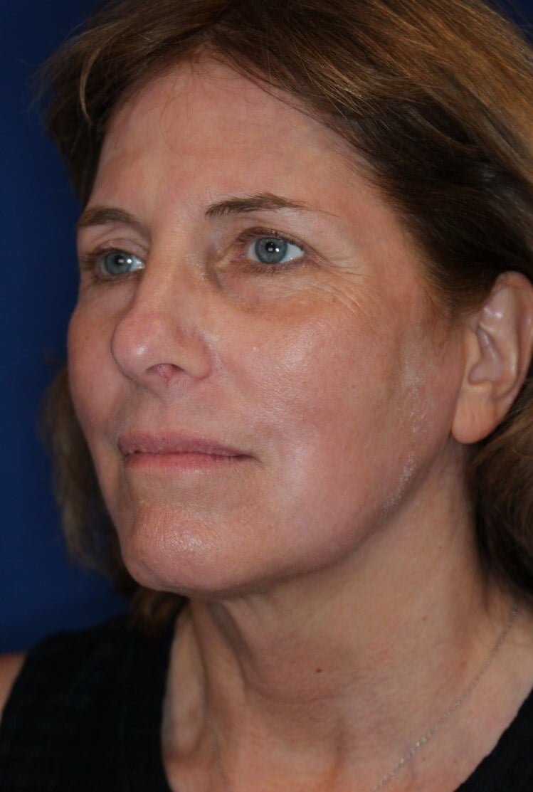 Laser Resurfacing After