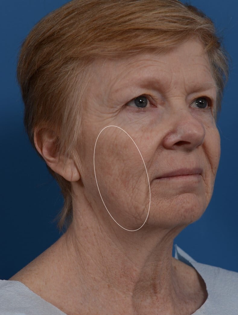 Laser Resurfacing Before