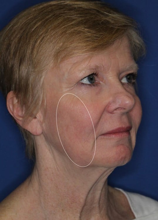 Laser Resurfacing After