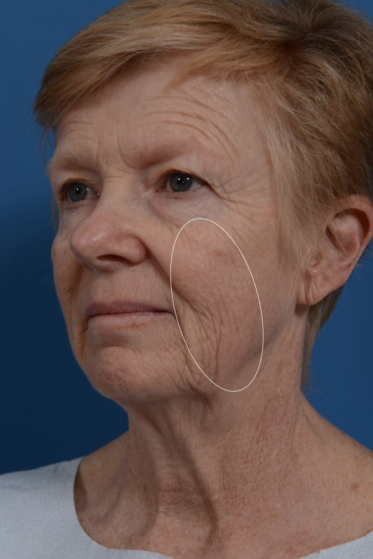 Laser Resurfacing Before