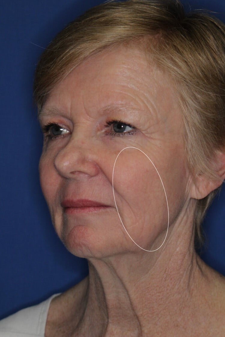 Laser Resurfacing After