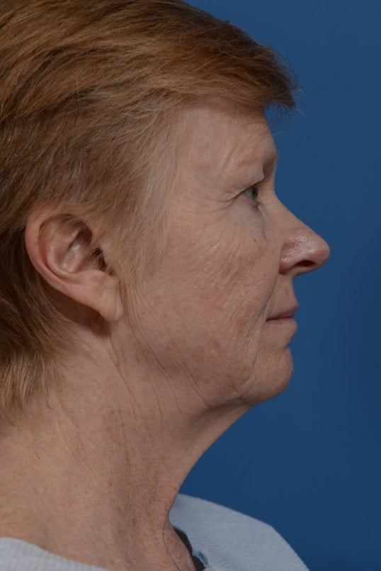 Laser Resurfacing Before