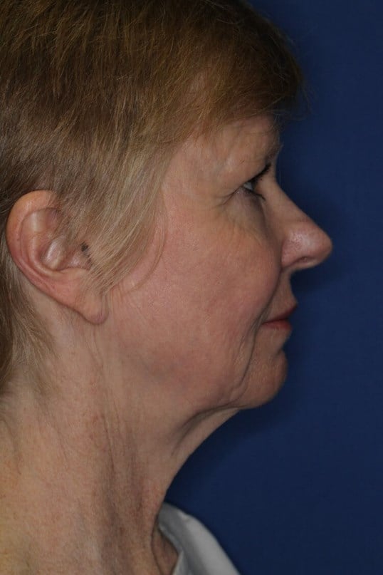 Laser Resurfacing After