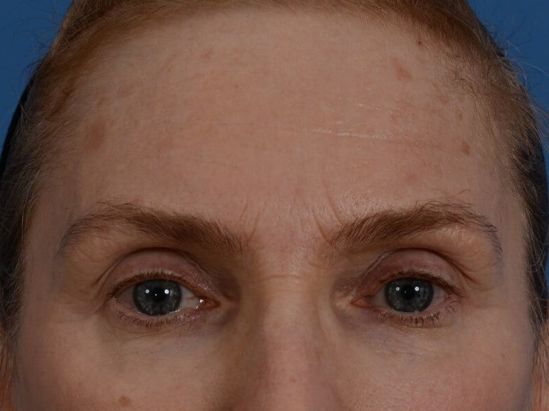 Laser & Fat Injection Before