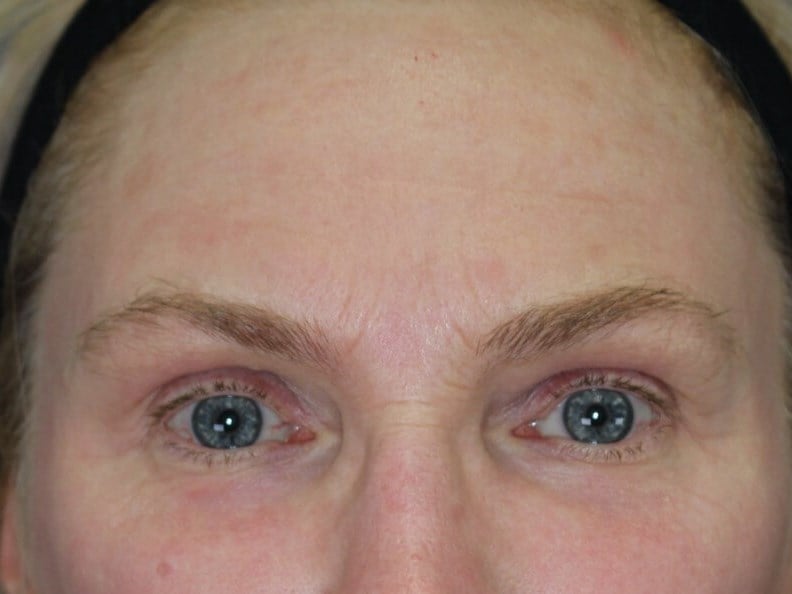 Laser & Fat Injection After